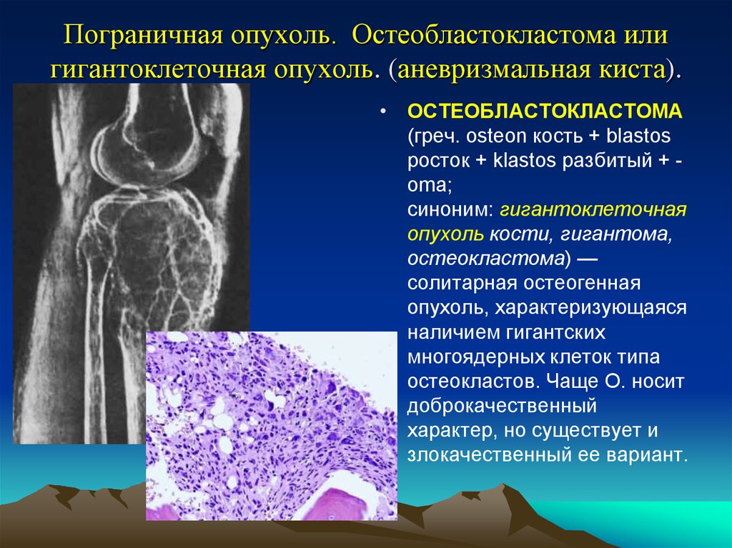 Опухоль из хрящевой ткани. (Остеобластокластома (гигантоклеточная опухоль. Гигантоклеточная опухоль гистология. Аневризмальная киста малоберцовой кости. Остеобластокластома бедра кт.