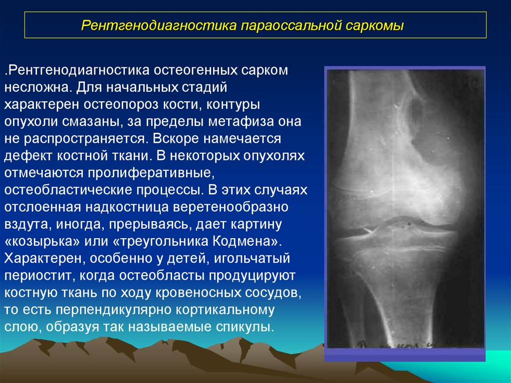 Диагноз саркома. Гигантоклеточная опухоль малоберцовой кости. Остеосаркома остеобластическая форма. Рентгенодиагностика опухолей костей. Опухоли костей рентгендиагностик.