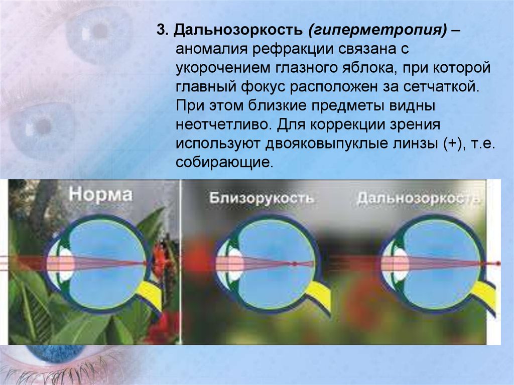 При близорукости изображение проецируется