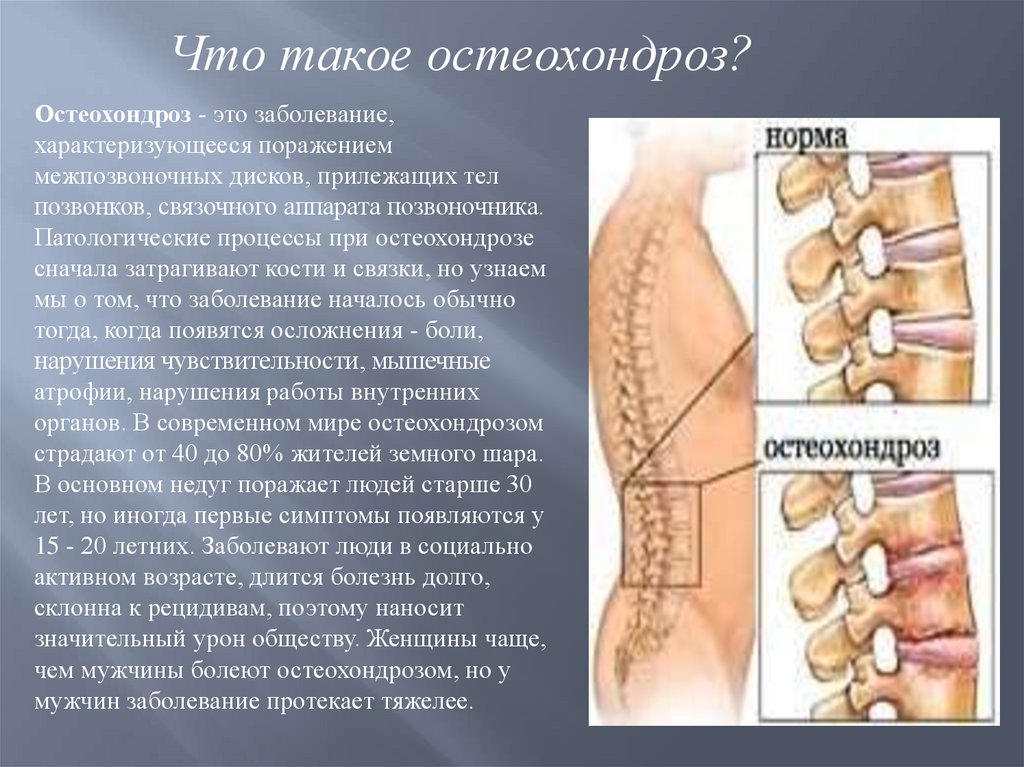 Остеохондроз позвоночника презентация