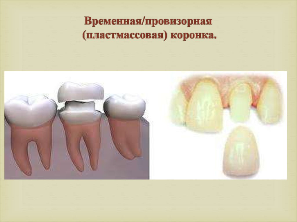 Временные коронки прямым методом. Временная пластмассовая коронка. Временная пластмасса для коронок. Временные Провизорные пластмассовые коронки.