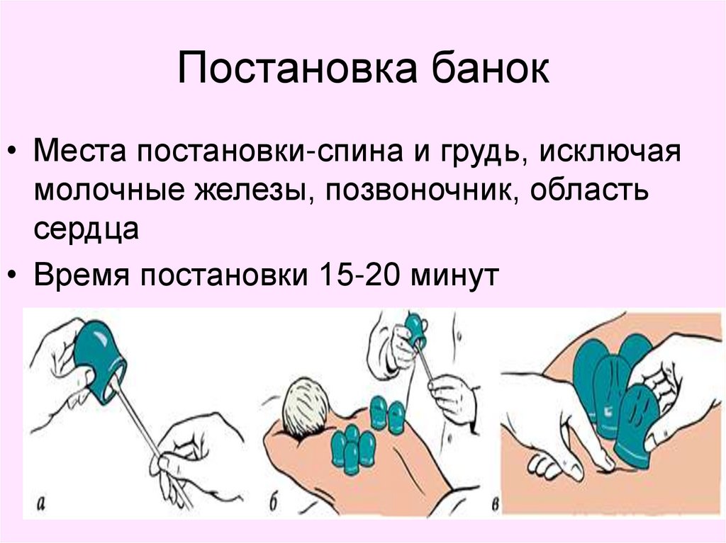 Как правильно банки. Постановка медицинских банок алгоритм. Постановка банок при бронхите алгоритм. Как ставить банки алгоритм. Постановка банок и горчичников.