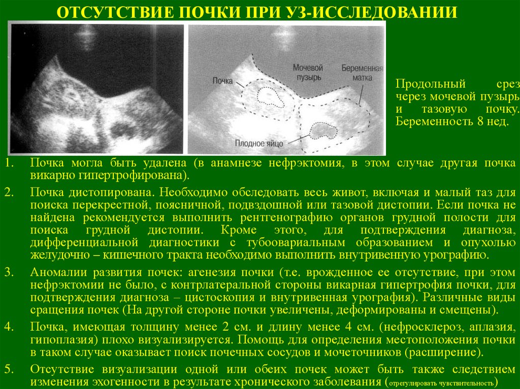 Почечный диагноз. Тазовая дистопия почки на УЗИ. Неполное удвоение почки на УЗИ протокол. Тазовая дистопия почки УЗИ заключение.