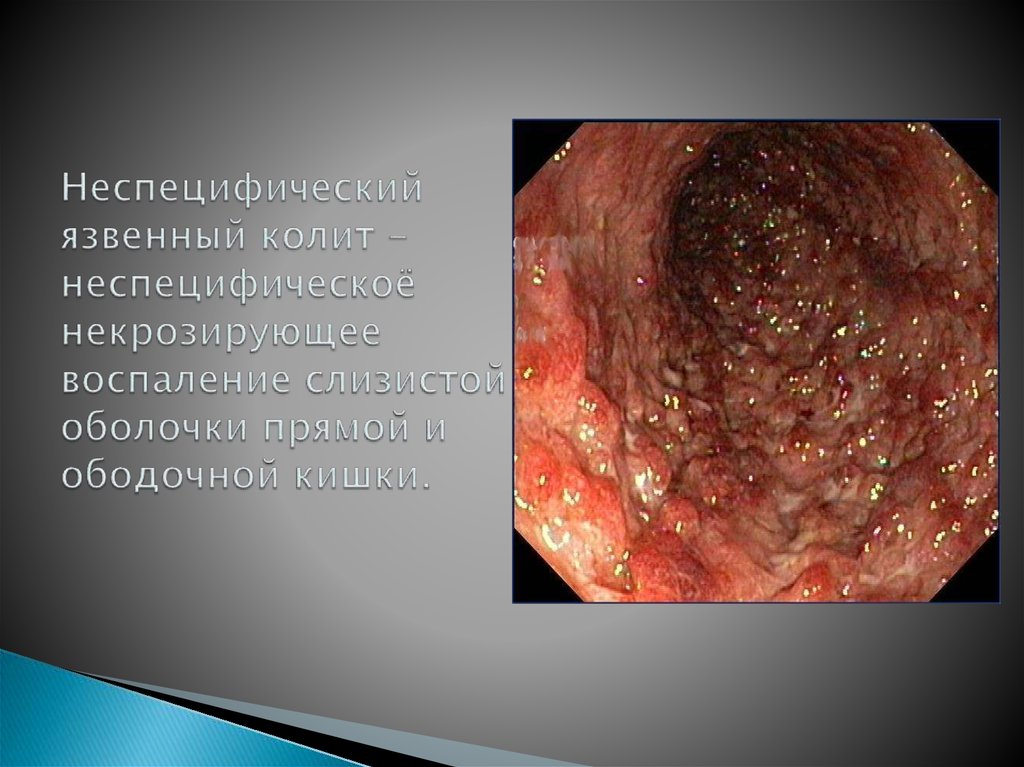 Неспецифический язвенный колит - неспецифическоё некрозирующее воспаление слизистой оболочки прямой и ободочной кишки.
