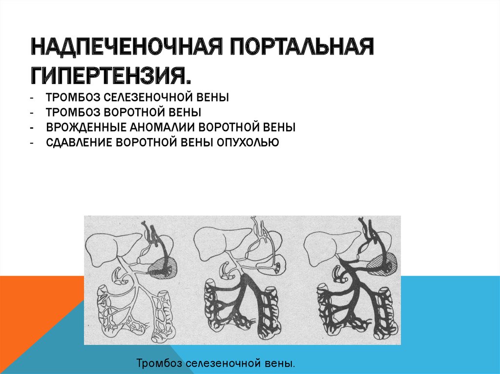 Врожденный венозный порок. Синдром портальной гипертензии надпеченочная форма. Надпеченочный блок портальной гипертензии. Надпеченочная портальная гипертензия проявляется. Аномалии воротной вены.