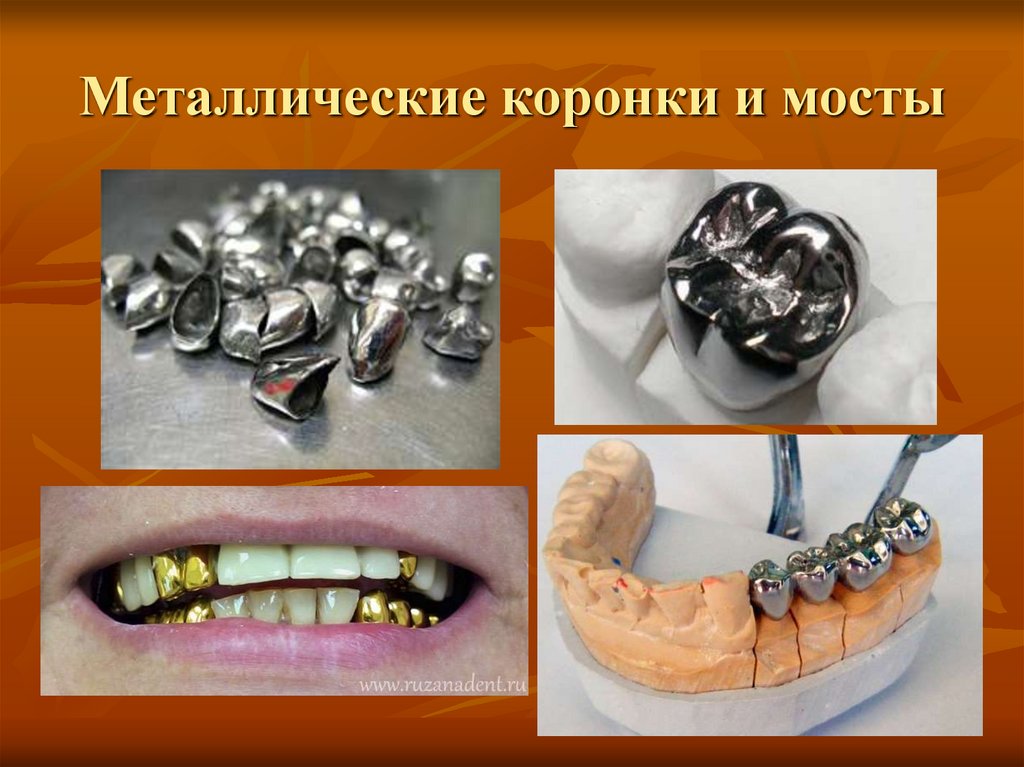 Что такое мосты на зубы с напылением