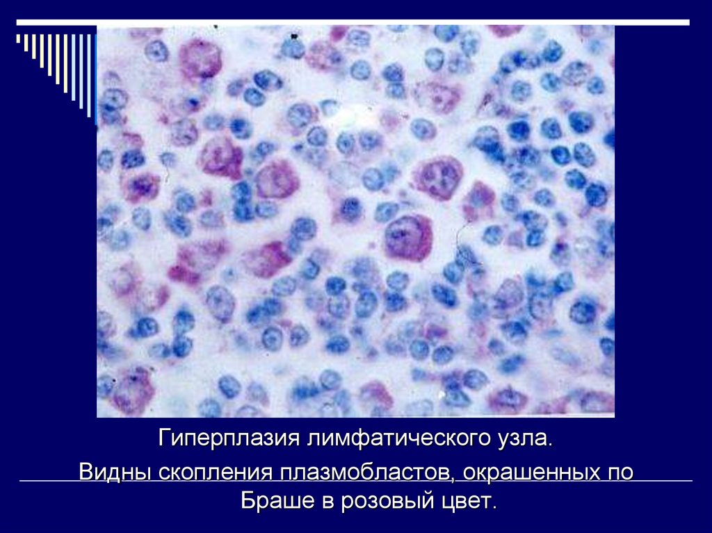 Гематогенный вторичный. Гематогенный туберкулез. Гематогенный туберкулез классификация. Морфология генерализованного гематогенного туберкулеза.