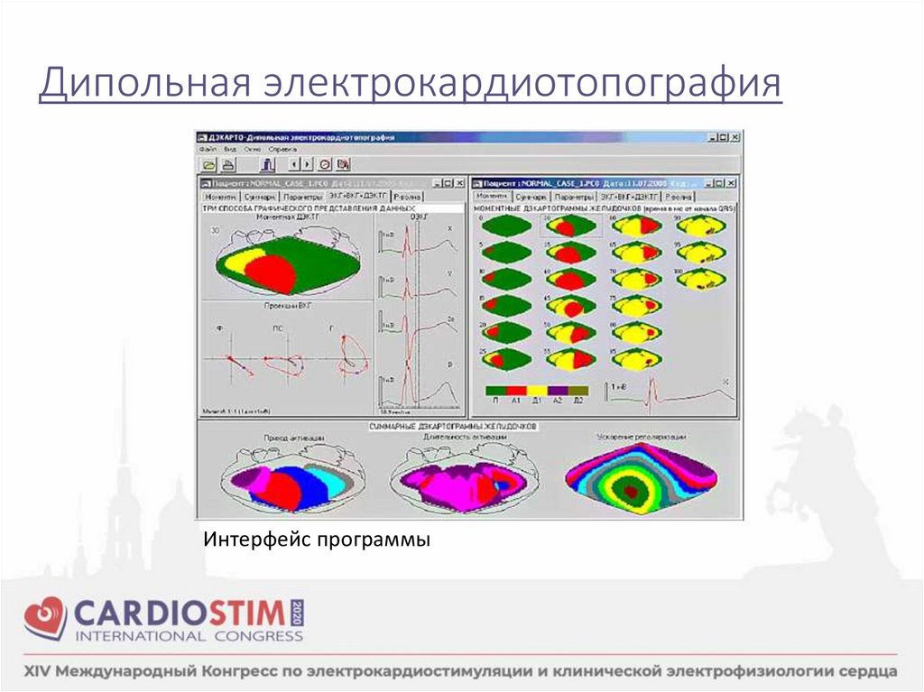 Дипольная электрокардиотопография