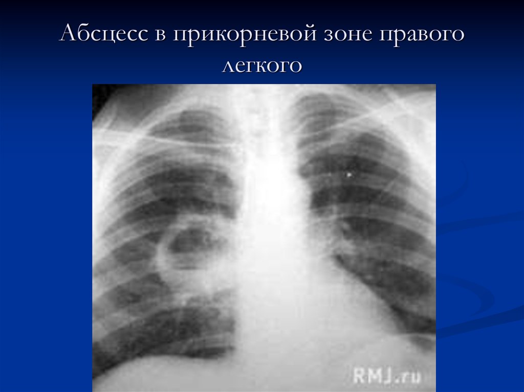 Зоны легкого. Абсцесс средней доли правого легкого. Прикорневая зона легких. Опорожнившийся абсцесс легкого.