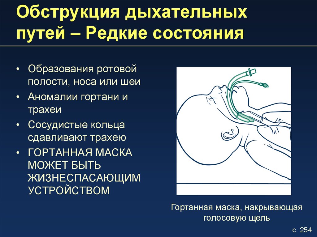 Виды обструкции дыхательных путей схема