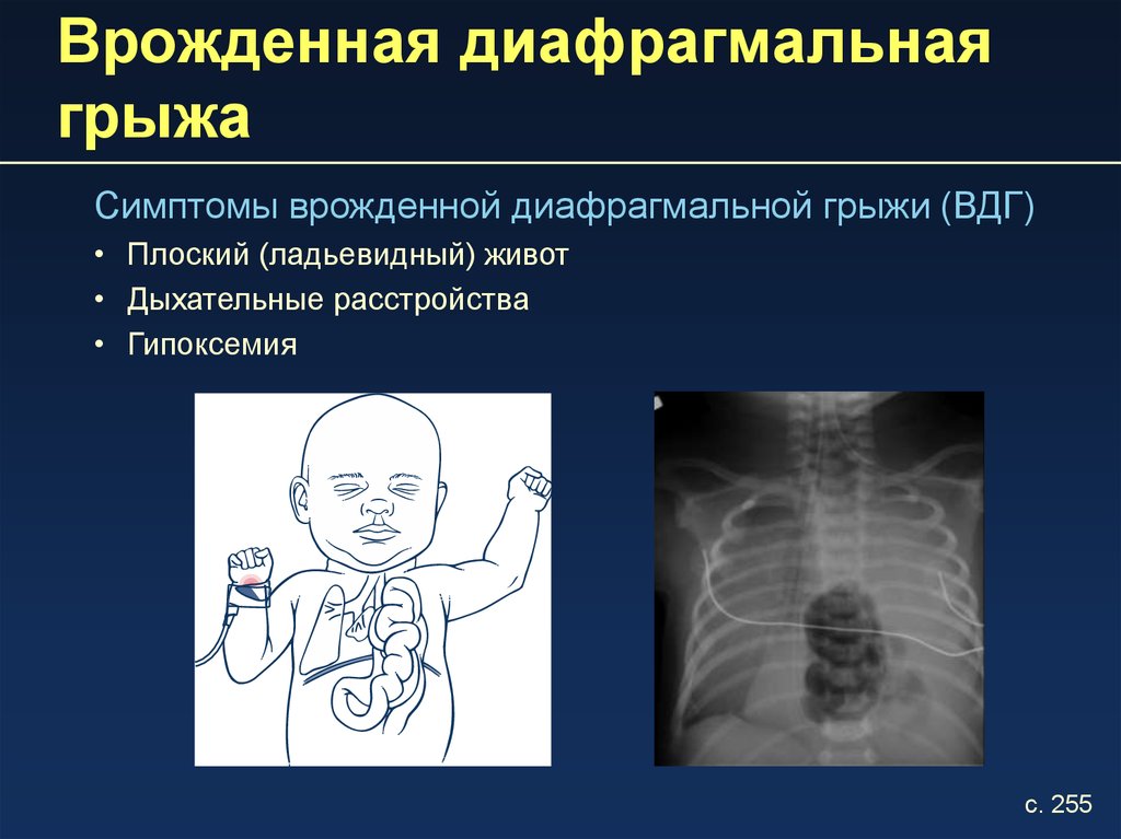 Диафрагмальная грыжа. Диафрагмальная грыжа невропатическая. Врожденная диафрагмальная грыжа. Поддиарагмальная грыжа. Левосторонняя диафрагмальная грыжа.