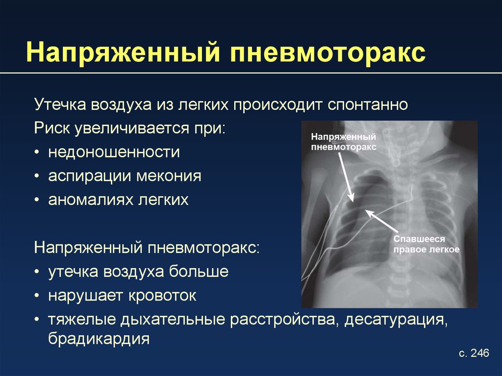 Напряженный пневмоторакс. Симптомы напряженного пневмоторакса. Пневмоторакс рентген симптомы. Ненапряженный пневмоторакс. Клапанный напряженный пневмоторакс рентген.