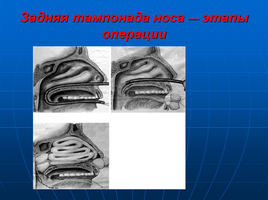 Передняя тампонада при носовом кровотечении