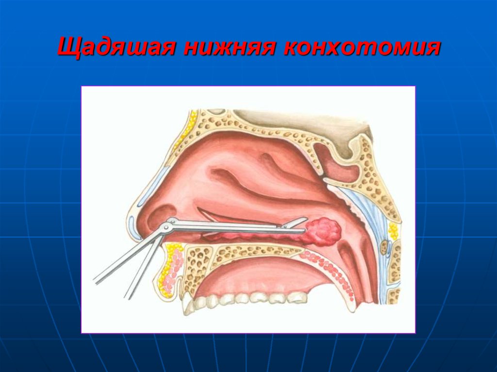 Что такое хронический ринит. Конхотомия нижних носовых раковин. Хирургическая вазотомия носовых раковин. Гипертрофический ринит. Щадящая конхотомия нижних носовых раковин.