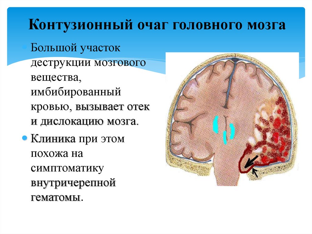 Контузионный очаг головного мозга