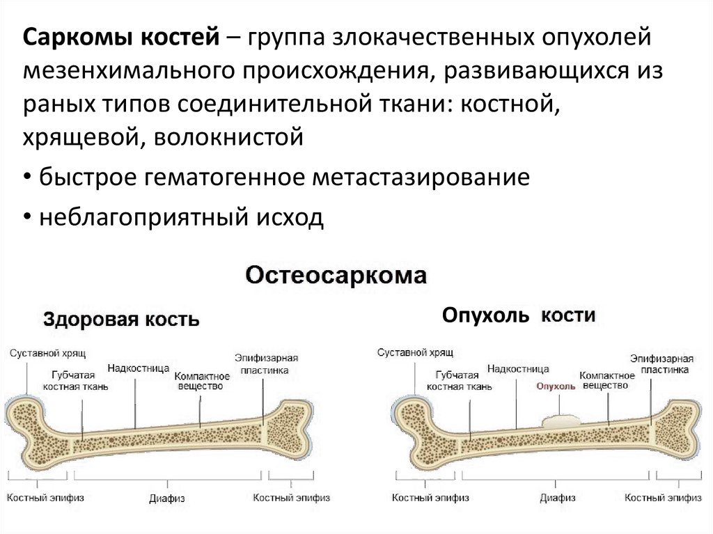 Диагностика костей. Остеогенная саркома трубчатой кости схема. Саркомы костей классификация. Остеогенная саркома схема. Саркома локтевой кости.