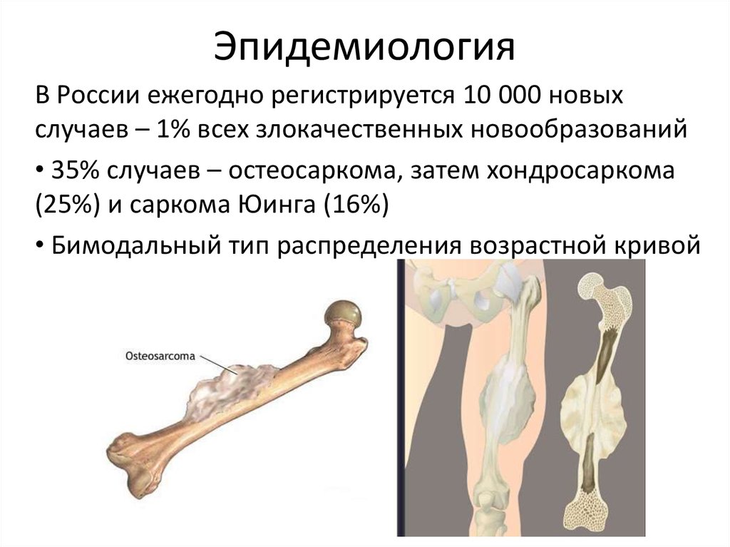 Злокачественные опухоли костей презентация