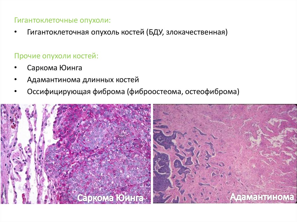 Злокачественные опухоли костей презентация