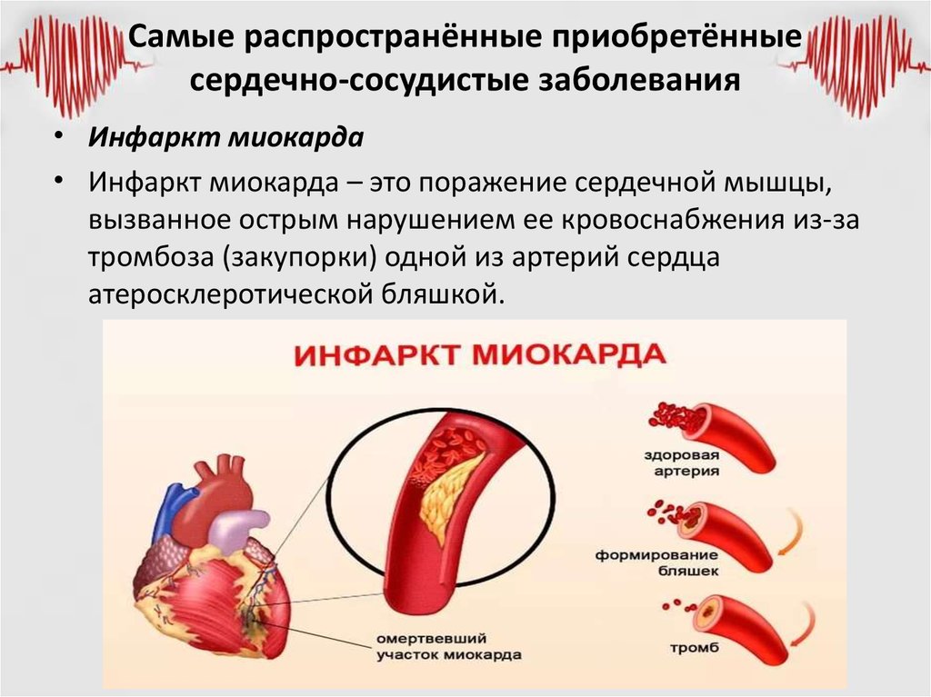 Причина заболевания сосудов. Сердечно-сосудистые заболевания. Заболевания сирдечнососудистой системы. Распространенные болезни сердца.
