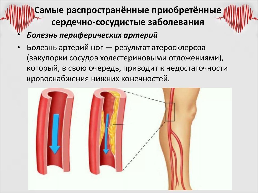 Заболевания артерий вен. Облитерирующий атеросклероз сосудов конечностей. Облитерирующий атеросклероз периферических артерий. Атеросклероз периферических сосудов. Заболевание периферических артерий и вен.