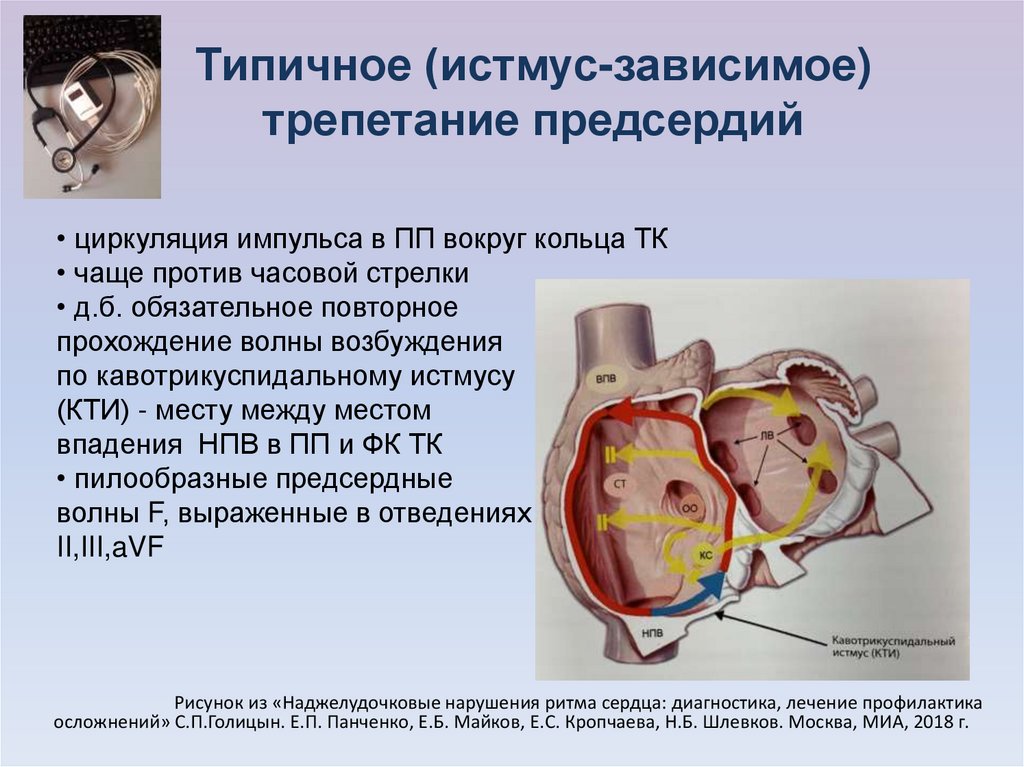 Трепетание предсердий карта вызова смп