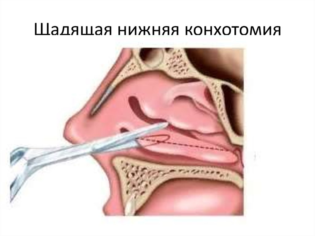 Нижняя подслизистая вазотомия. Конхотомия нижних носовых раковин. Вазомоторный ринит носовые раковины. Щадящая нижняя конхотомия.