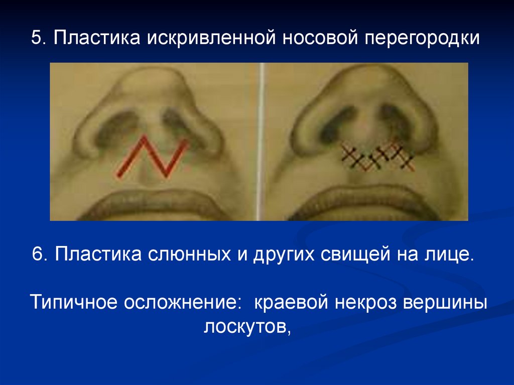 Пластика местными тканями презентация