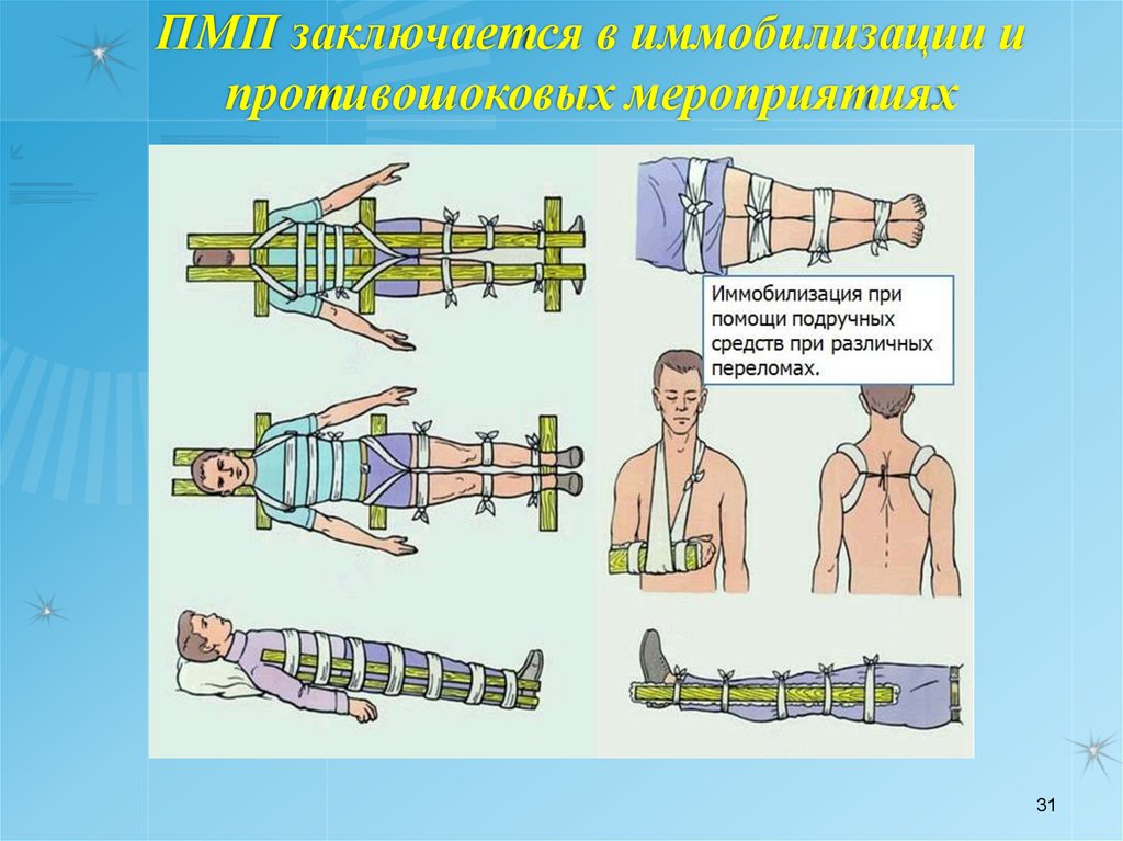 Система иммобилизации. Иммобилизация поврежденной конечности. Иммобилизация при переломе. Транспортная иммобилизация при травмах.