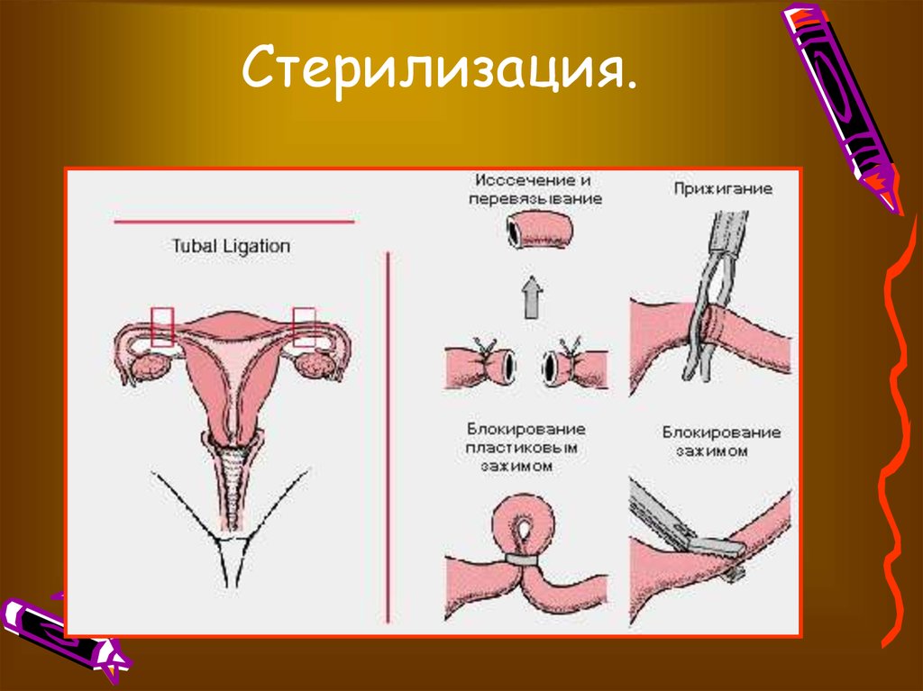 как проходит операция по стерилизации женщины