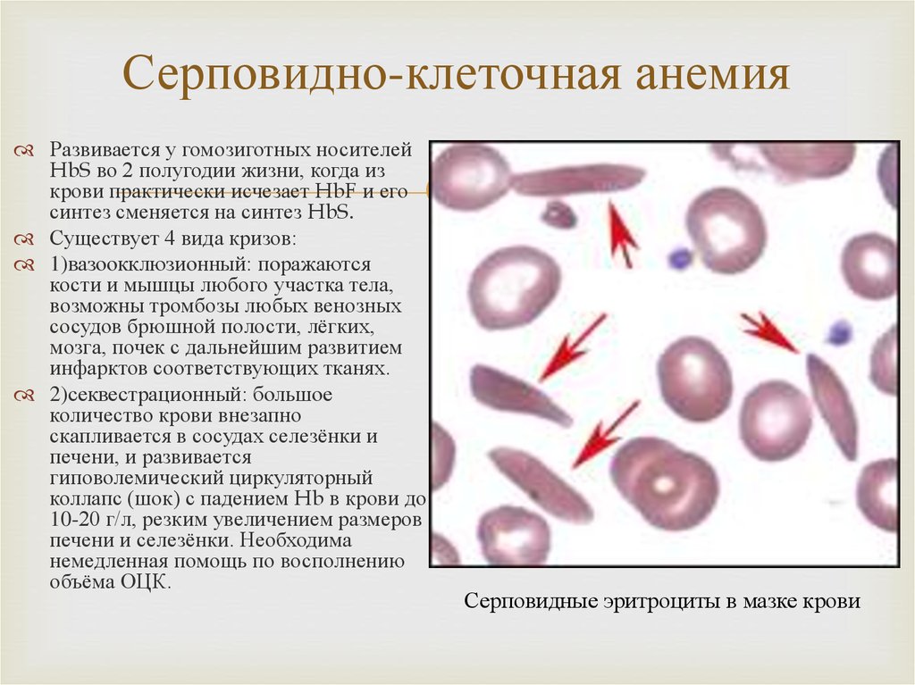 Серповидно клеточная анемия признаки