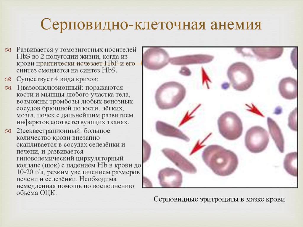 Серповидноклеточная анемия картина крови