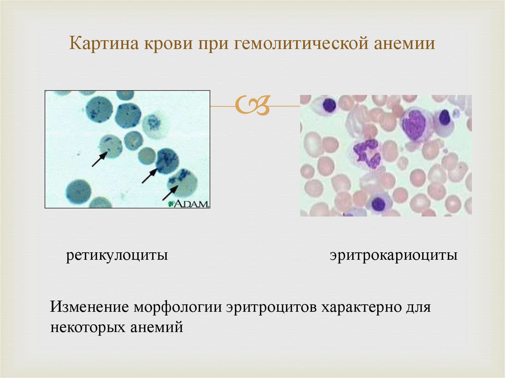 Изменение клеток крови. Ретикулоциты морфология. Ретикулоциты микроскопия. Ретикулоциты классификация. Изменение морфологии эритроцитов при анемиях.