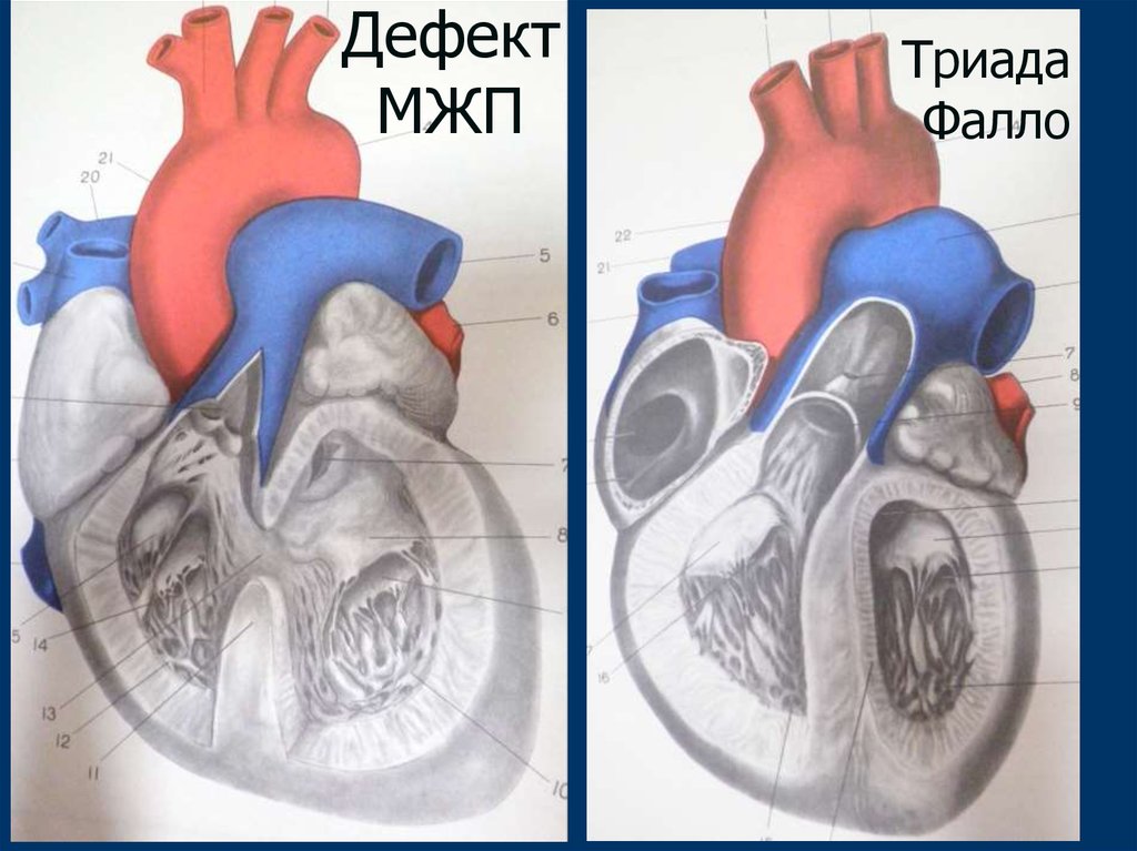 Тетрада фалло мкб