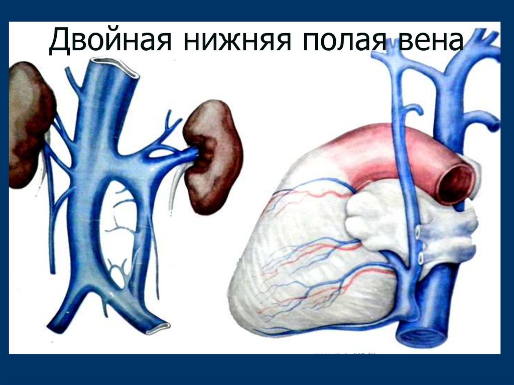 Нижняя полая вена образуется. Нижняя полая Вена анатомия. Аномалии развития нижней полой вены. Аплазия нижней полой вены.