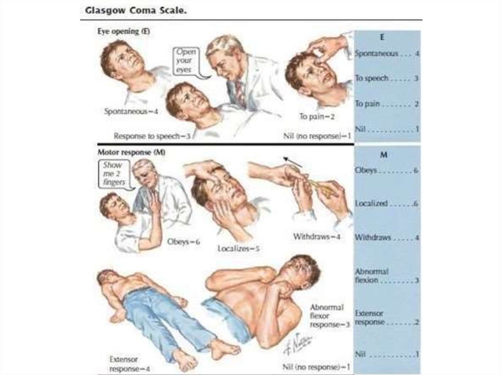 Кома краткое содержание. The Glasgow coma Scale. Реакция Глазго. Оценка сознания у новорожденных. Глубокая кома по ШКГ.