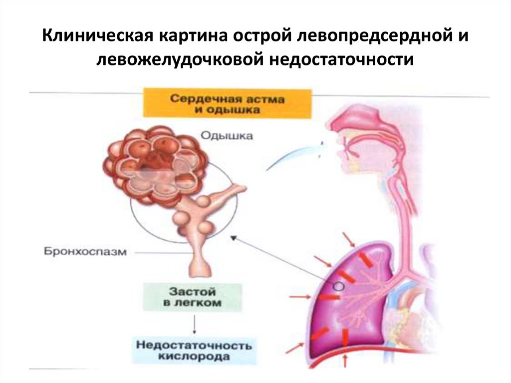 Острая сердечная недостаточность рекомендации