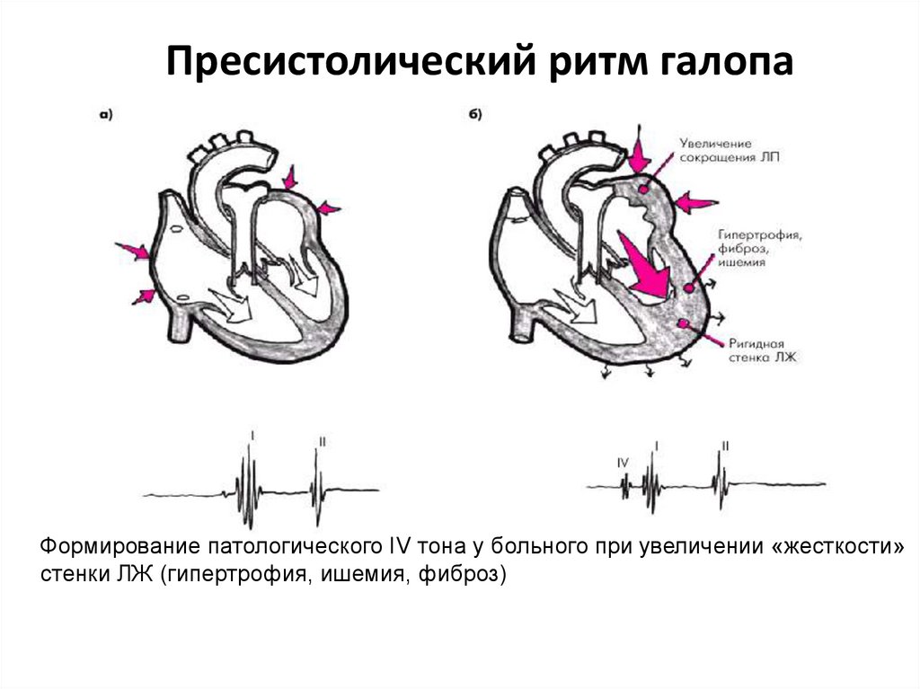 Схема ритма галопа