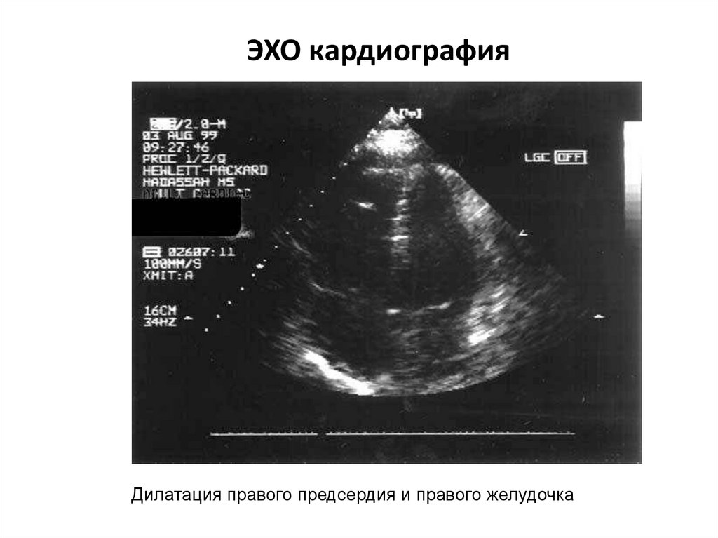 Дилатация предсердий. Дилатация правого желудочка ЭХОКГ. Дилатация левого желудочка ЭХОКГ. Эхо кг дилатация правого желудочка. УЗИ дилатация левого желудочка.