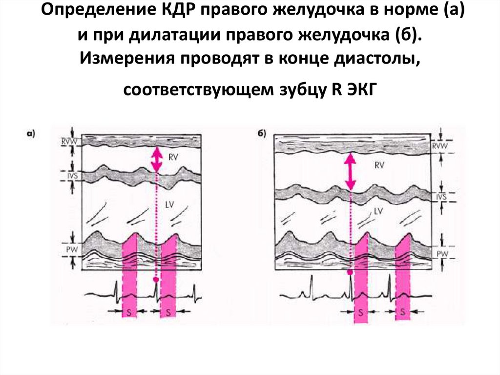 Кдр левого желудочка. КДР правого желудочка норма. КДР левого желудочка норма. КДР левого желудочка норма у детей. КДР норма.