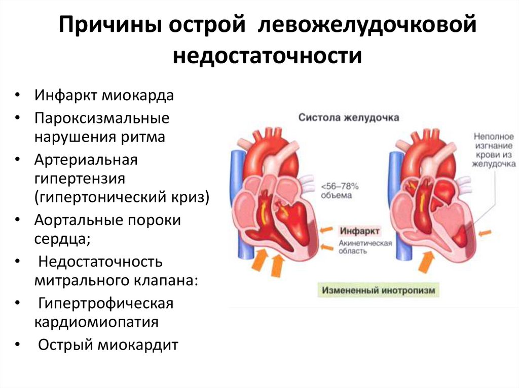 Какая бывает сердечная недостаточность. Проявления синдрома острой сердечной недостаточности. Причины развития острой сердечной недостаточности. Симптомы острой левожелудочковой сердечной недостаточности. Причины острой левожелудочковой недостаточности.