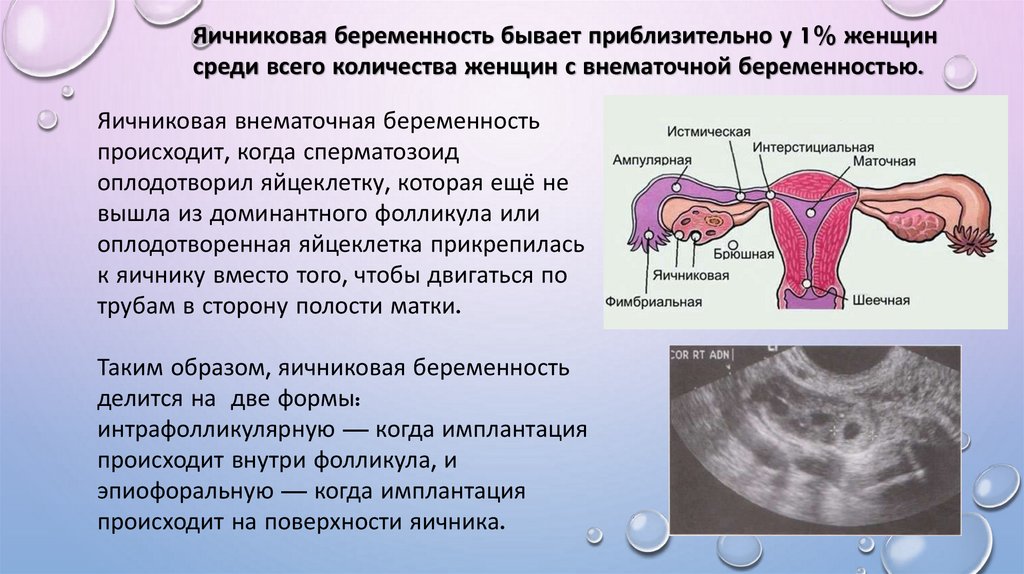 Беременность после внематочной отзывы. Внематочная беременность. Внематочная беременнос. Внематочная беременность симптомы. Фимбриальная Трубная беременность.