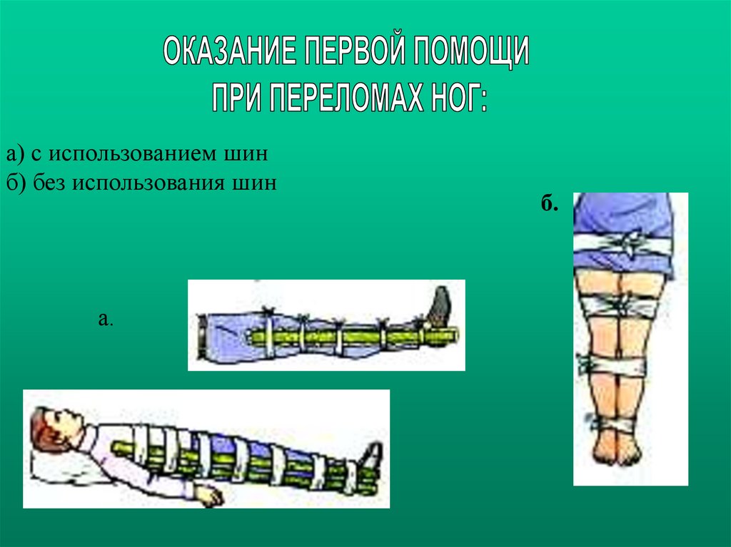 Первая помощь при переломах обж презентация