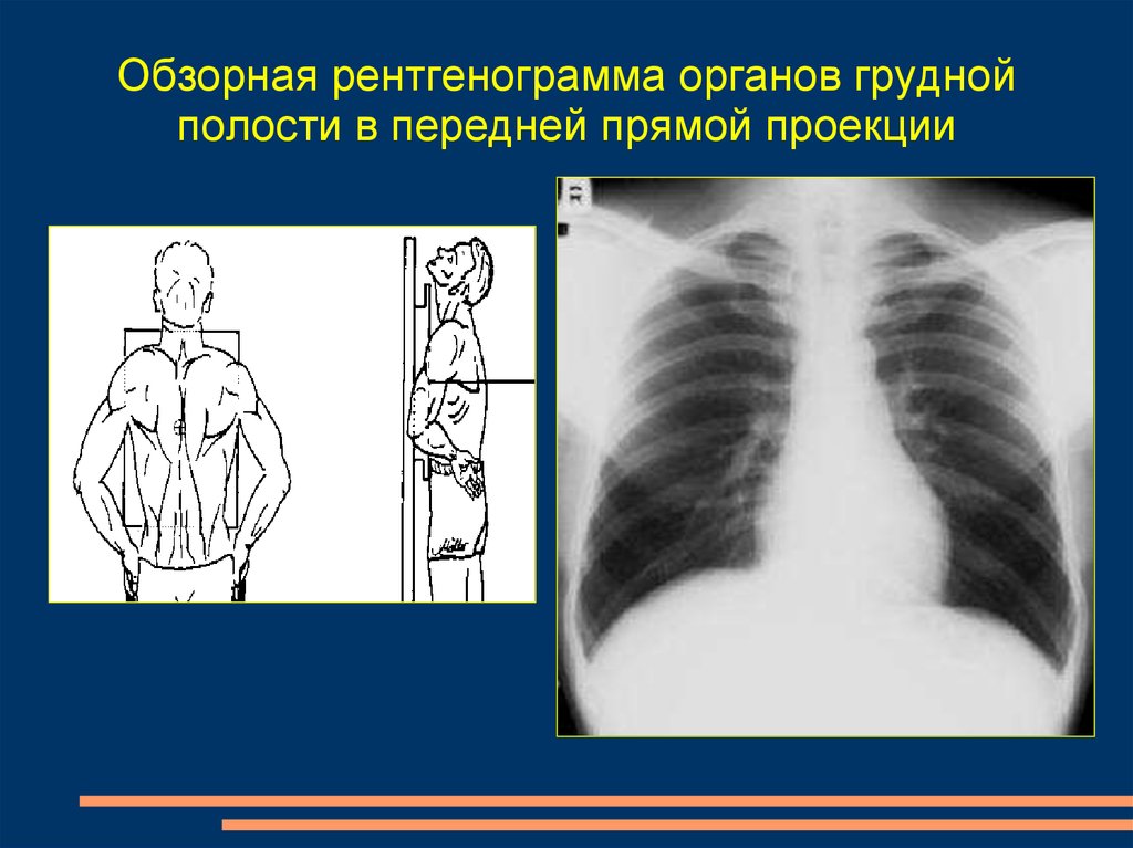 Обзорная рентгенограмма органов грудной полости в передней прямой проекции