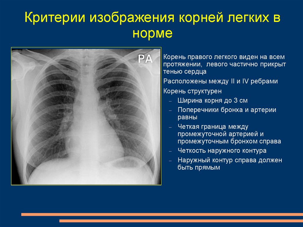 Изменения легочного и корневого рисунка