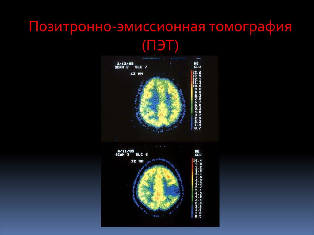 Эмиссионная томография. Позитронно-эмиссионная томография (ПЭТ). Метод позитронно-эмиссионной томографии (ПЭТ). Оборудование для позитронной эмиссионной томографии. Позитронная эмиссионная томография основана на:.