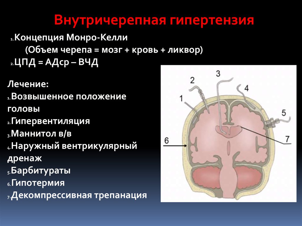 Вчг. Внутричерепная гипертензия. Синдром внутричерепной гипертензии. Внутренне черепная гипертензия. Идиопатическая внутричерепная гипертензия.
