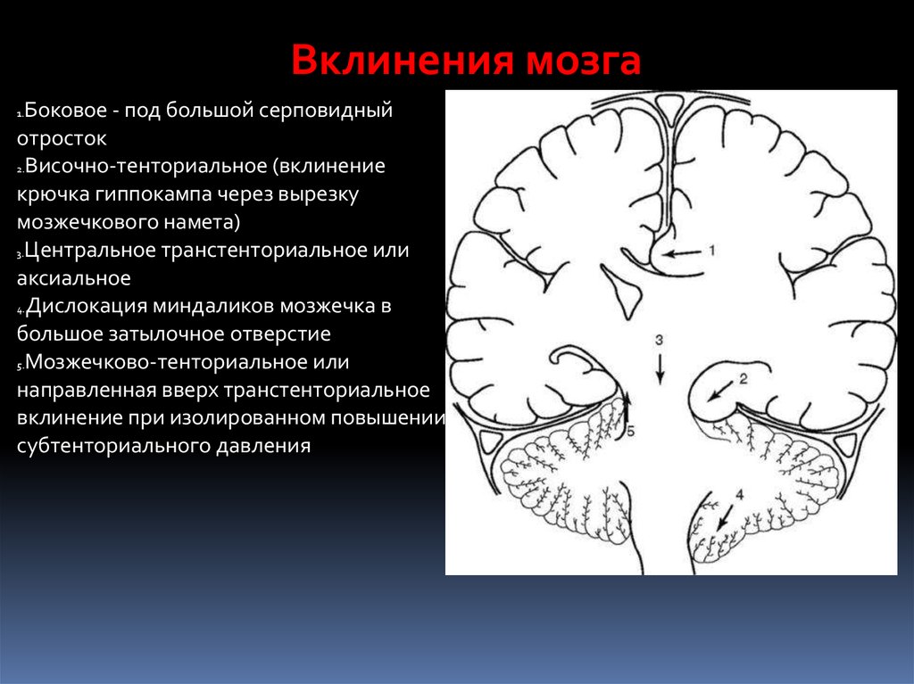 Каудоталамическая вырезка. Синдром дислокации мозговых структур. Симптомы вклинения мозжечка. Синдром дислокации головного мозга. Вклинение ствола головного.