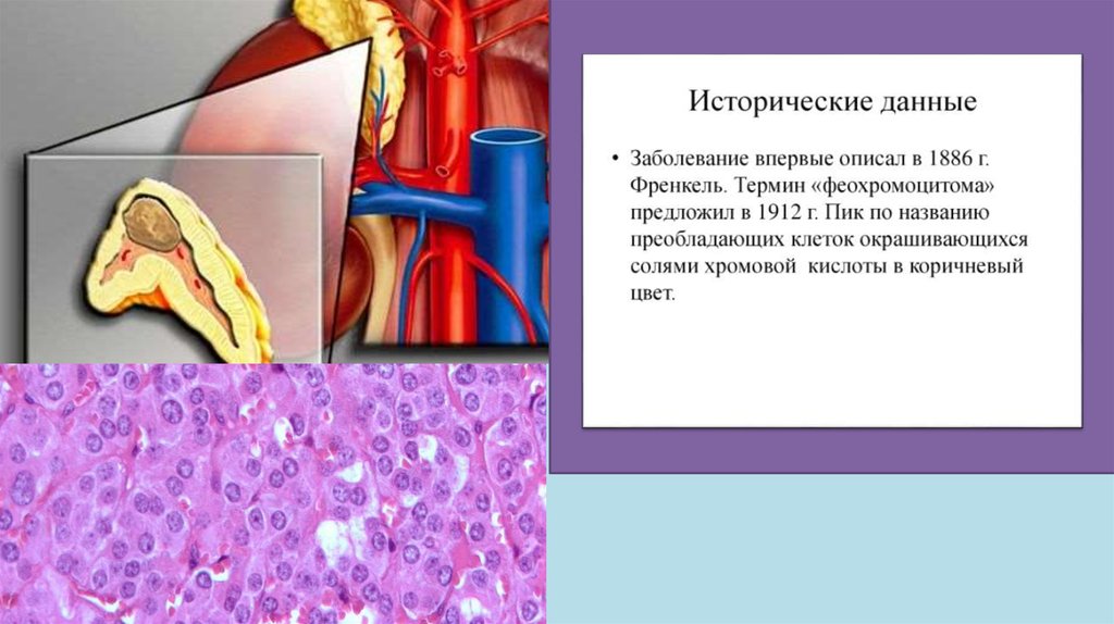 Феохромоцитома презентация по эндокринологии