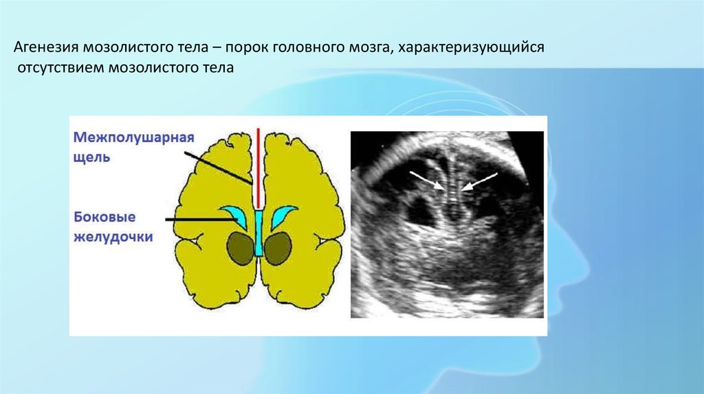 Агенезия венозного. УЗИ головного мозга мозолистое тело. ВПР ЦНС плода агенезия мозолистого. Врожденная аномалия мозолистого тела что это такое. Агнезиия мозолистого тела.