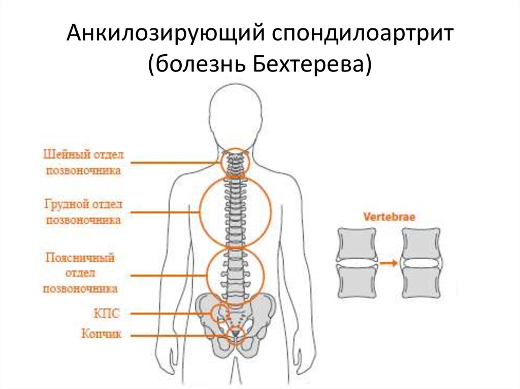 Болезнь бехтерева презентация госпитальная терапия